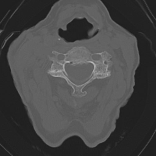C2 fracture with vertebral artery dissection (Radiopaedia 37378-39199 Axial bone window 26).png