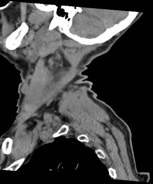 C2 fracture with vertebral artery dissection (Radiopaedia 37378-39199 D 69).png