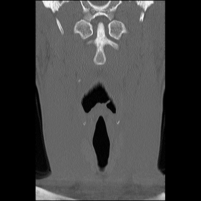C5 facet fracture (Radiopaedia 58374-65499 Coronal bone window 17).jpg