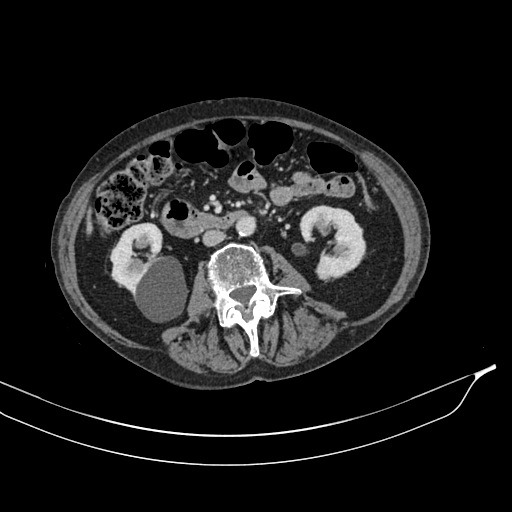 Calcified adrenal glands and Spigelian hernia (Radiopaedia 49741-54988 A 106).jpg