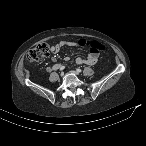 Calcified adrenal glands and Spigelian hernia (Radiopaedia 49741-54988 A 151).jpg