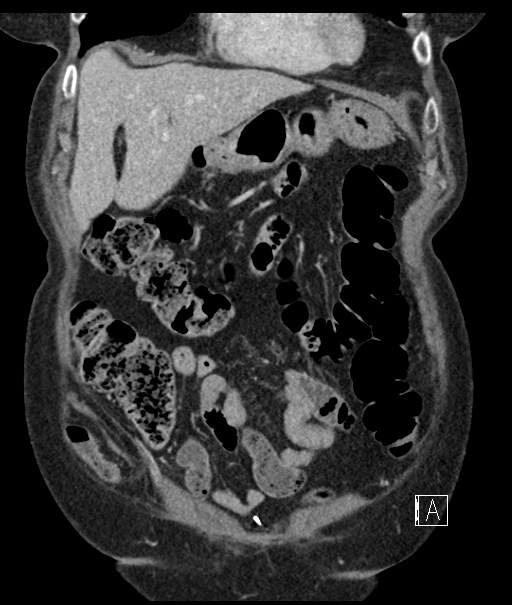 Calcified adrenal glands and Spigelian hernia (Radiopaedia 49741-54988 B 28).jpg
