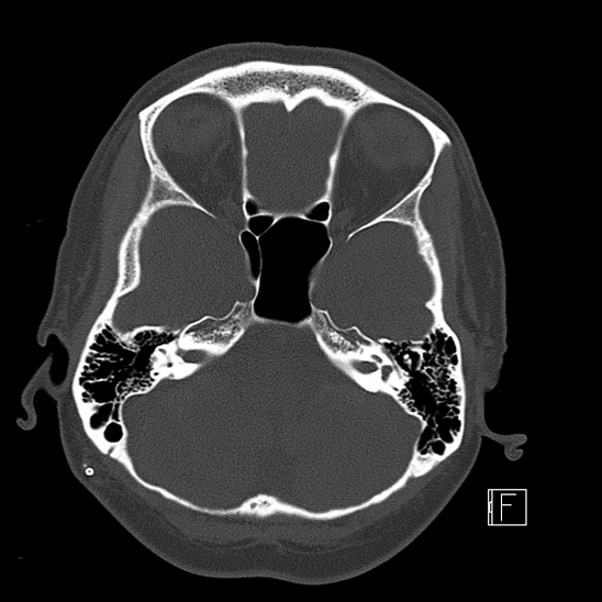 File:Calcified chronic subdural hematoma (Radiopaedia 77374-89492 Axial bone window 30).jpg