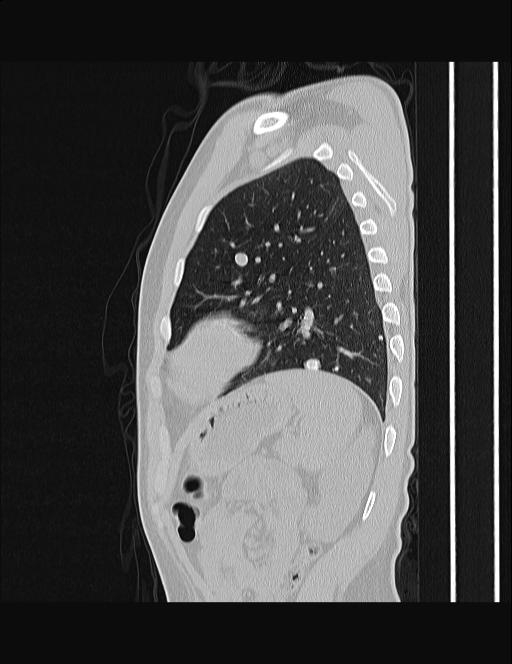 Calcifying pulmonary metastases (Radiopaedia 33359-34396 Sagittal lung window 17).jpg