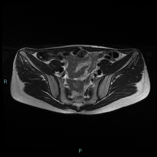 File:Canal of Nuck cyst (Radiopaedia 55074-61448 Axial T2 2).jpg