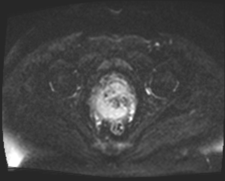 Cancer cervix - stage IIb (Radiopaedia 75411-86615 Axial DWI 38).jpg