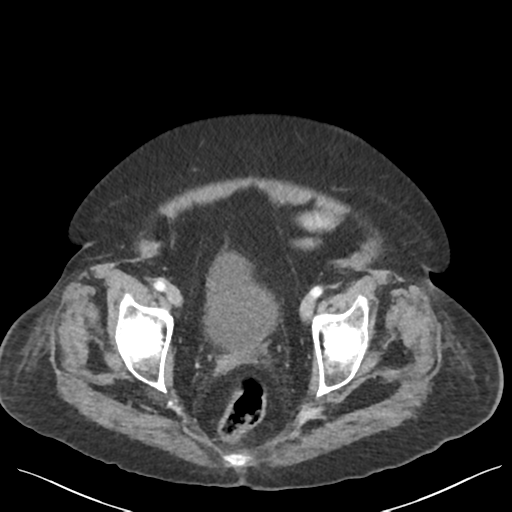 Cannonball metastases from endometrial cancer (Radiopaedia 42003-45031 E 68).png