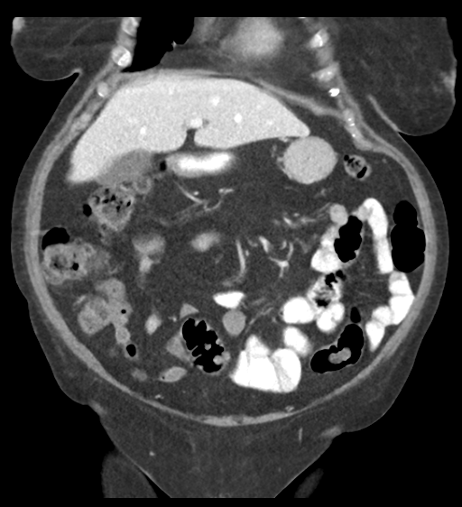 Cannonball metastases from endometrial cancer (Radiopaedia 42003-45031 F 24).png