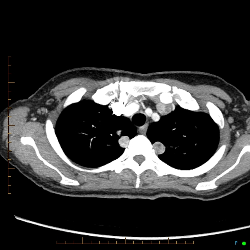 Canonball lung metastasis (Radiopaedia 77634-89837 B 15).jpg