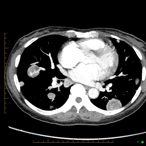 Canonball lung metastasis (Radiopaedia 77634-89837 B 56).jpg