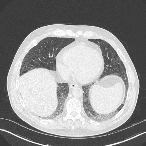Caplan syndrome (Radiopaedia 56667-63530 Axial lung window 144).jpg