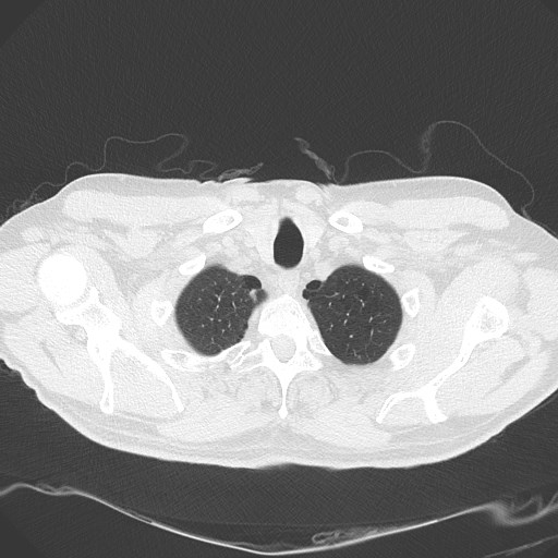 Caplan syndrome (Radiopaedia 56667-63530 Axial lung window 26).jpg