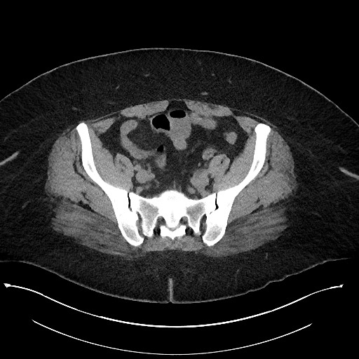 Carcinoid tumor - terminal ileum (Radiopaedia 60931-68740 Axial non-contrast 92).jpg