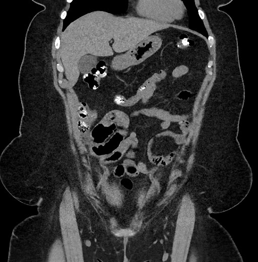 Carcinoid tumor - terminal ileum (Radiopaedia 60931-68740 Coronal non-contrast 24).jpg
