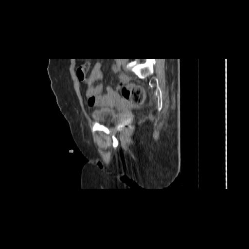 File:Carcinoma cervix- brachytherapy applicator (Radiopaedia 33135-34173 D 65).jpg