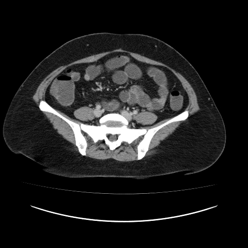 File:Carcinoma colon - hepatic flexure (Radiopaedia 19461-19493 A 89).jpg
