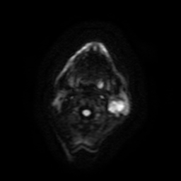 Carcinoma ex-pleomorphic adenoma of parotid (Radiopaedia 28383-28627 Ax DWI B-500 GE 50).jpg