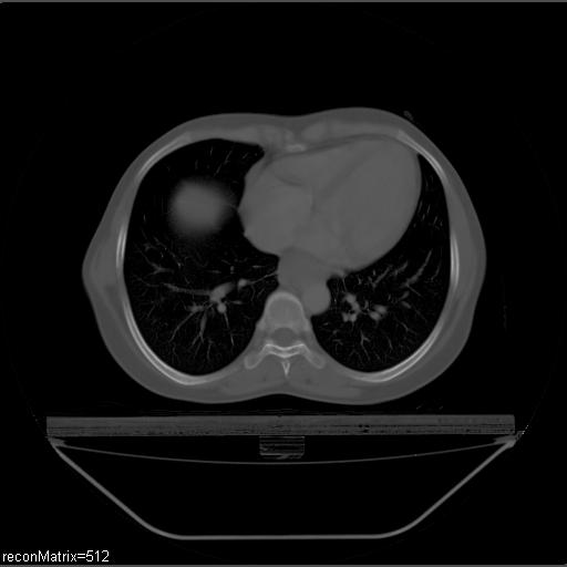File:Carcinoma of esophagus (Radiopaedia 27356-27550 Axial bone window 13).jpg