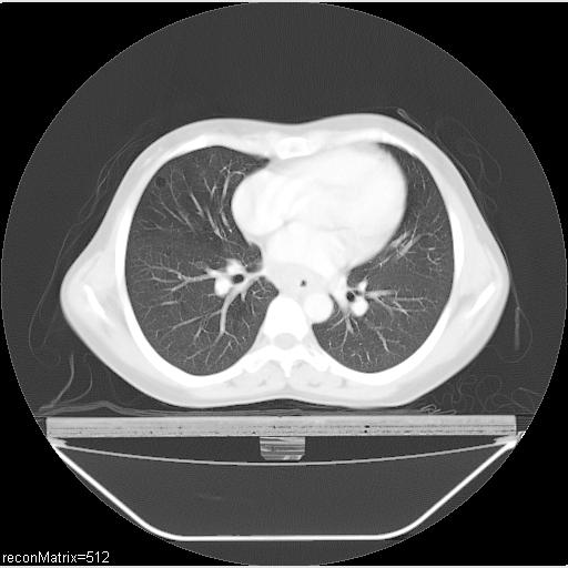 File:Carcinoma of esophagus (Radiopaedia 27356-27550 Axial lung window 16).jpg