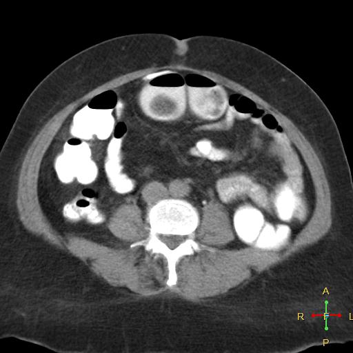File:Carcinoma of sigmoid colon (Radiopaedia 23071-23100 C+ delayed 13).jpg