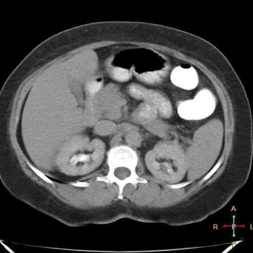File:Carcinoma of sigmoid colon (Radiopaedia 23071-23100 C+ delayed 6).jpg