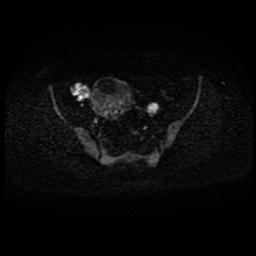 Carcinoma of the cervix (Radiopaedia 89018-105858 Axial DWI 39).jpg
