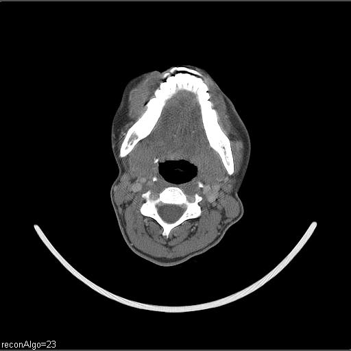 File:Carcinoma of the maxillary antrum (Radiopaedia 53805-59888 Axial C+ delayed 33).jpg