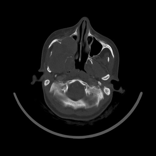 Carcinoma of the maxillary antrum (Radiopaedia 53805-59888 Axial bone window 49).jpg