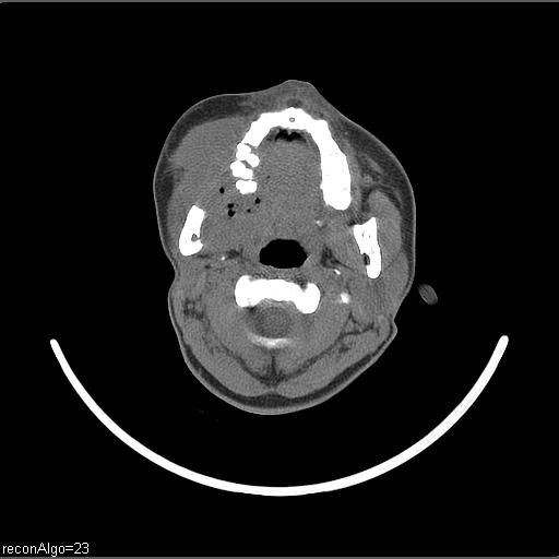 Carcinoma of the maxillary antrum (Radiopaedia 53805-59888 Axial non-contrast 50).jpg
