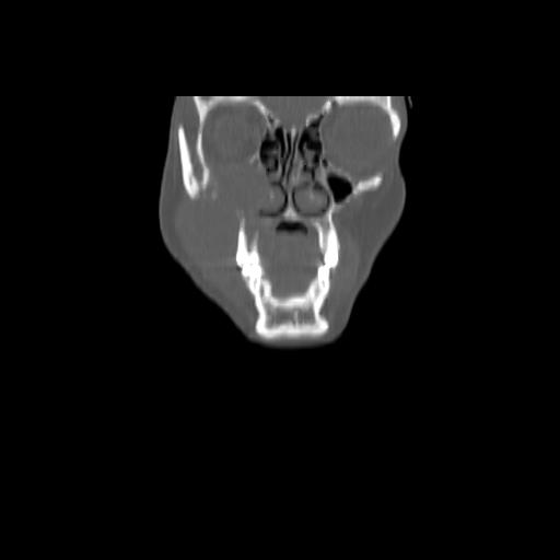 Carcinoma of the maxillary antrum (Radiopaedia 53805-59888 Coronal bone window 29).jpg