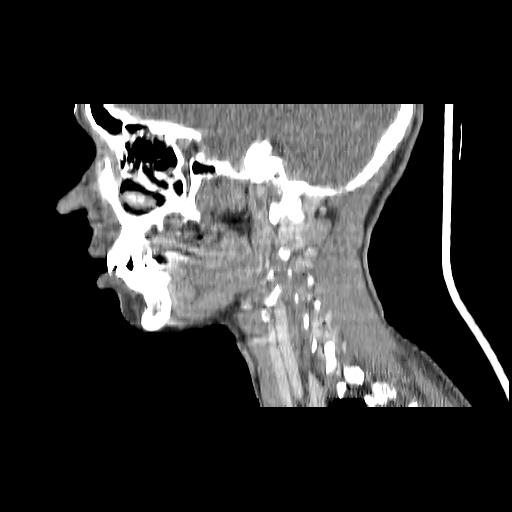 Carcinoma of the maxillary antrum (Radiopaedia 53805-59888 Sagittal C+ delayed 118).jpg