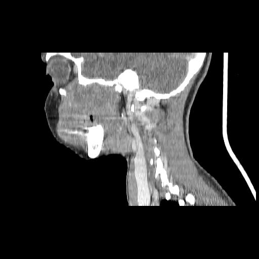 Carcinoma of the maxillary antrum (Radiopaedia 53805-59888 Sagittal C+ delayed 61).jpg