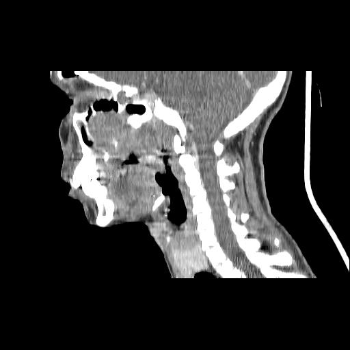Carcinoma of the maxillary antrum (Radiopaedia 53805-59888 Sagittal C+ delayed 83).jpg