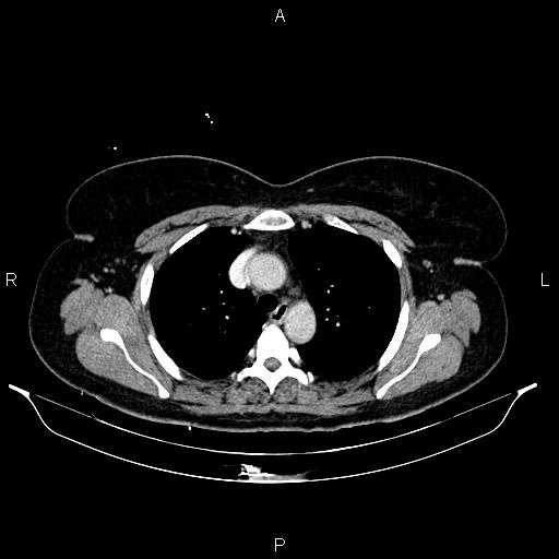 Carcinoma of uterine cervix (Radiopaedia 85861-101700 A 14).jpg
