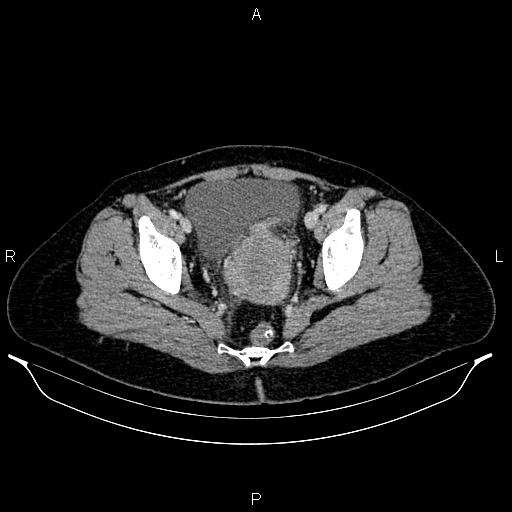 Carcinoma of uterine cervix (Radiopaedia 85861-101700 A 70).jpg