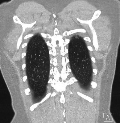 Cardiac sarcoidosis (Radiopaedia 74548-85534 Coronal lung window 61).jpg