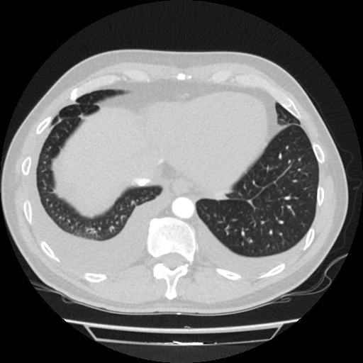 File:Cardiac tamponade (Radiopaedia 78607-91368 Axial lung window 76).jpg