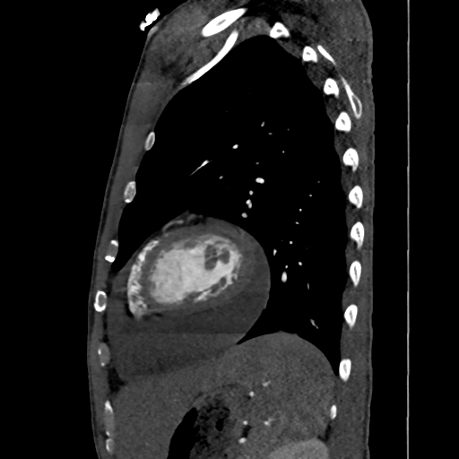 Cardiac tumor - undifferentiated pleomorphic sarcoma (Radiopaedia 45844-50134 B 16).png