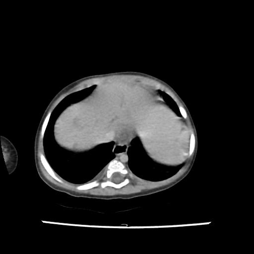 Caroli disease with autosomal recessive polycystic kidney disease (ARPKD) (Radiopaedia 89651-106703 B 17).jpg