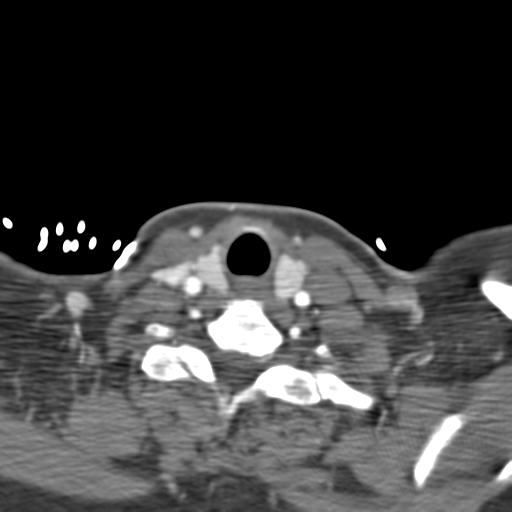 File:Carotico ophthalmic aneurysm (Radiopaedia 42916-46148 A 83).png