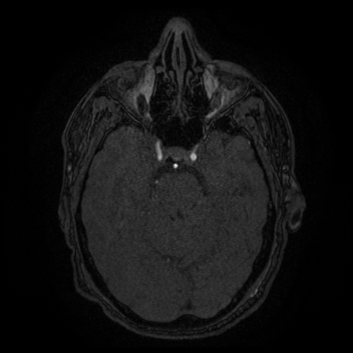 Carotid arterial dissection with acute cerebral infarction (Radiopaedia 26636-26784 MRA 113).jpg
