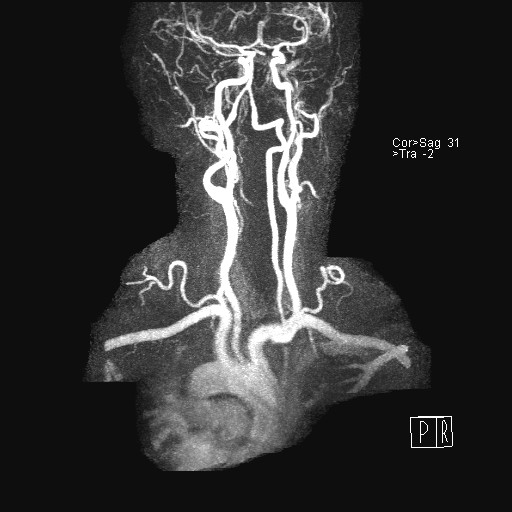 File:Carotid artery dissection (Radiopaedia 28441-28689 MIP Carotids MRA 18).jpg