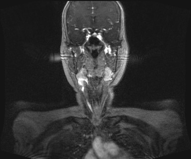 Carotid body tumor (Radiopaedia 12777-12912 MRA 21).jpg