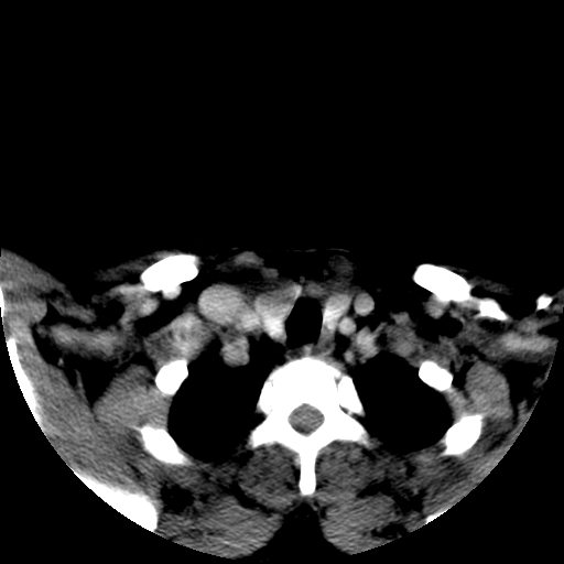 File:Carotid body tumor (Radiopaedia 27890-28124 A 28).jpg