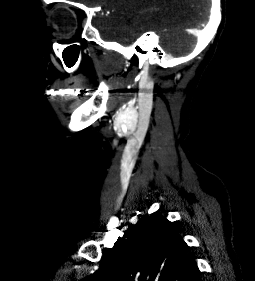 File:Carotid body tumor (Radiopaedia 39845-42300 D 12).jpg