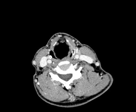 Carotid body tumor (Radiopaedia 61750-69757 Axial Post contrast 72).jpg