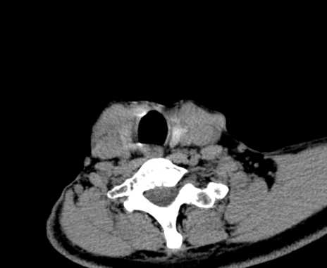 File:Carotid body tumor (Radiopaedia 61750-69757 Axial non-contrast 90).jpg