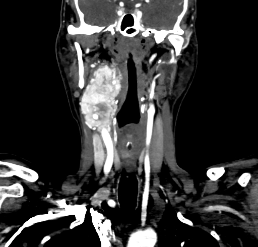 File:Carotid body tumor (Radiopaedia 83615-98727 B 63).jpg