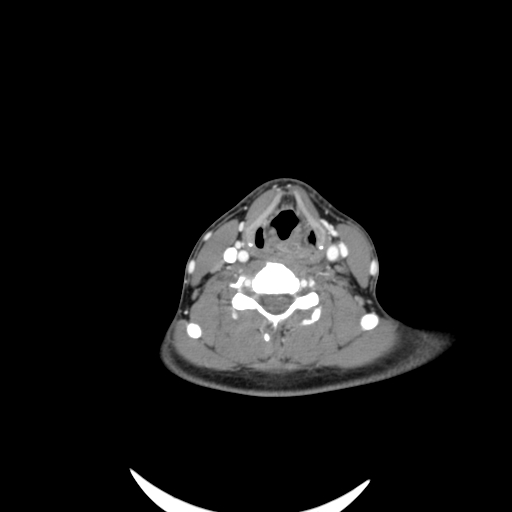 Carotid bulb pseudoaneurysm (Radiopaedia 57670-64616 A 45).jpg