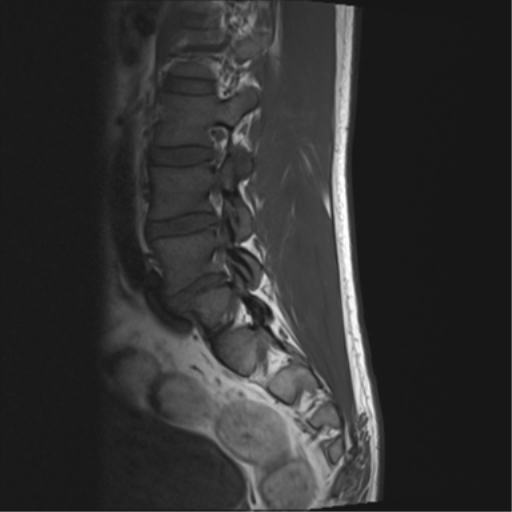 File:Cauda equina syndrome (Radiopaedia 53615-59672 Axial T1 5).png